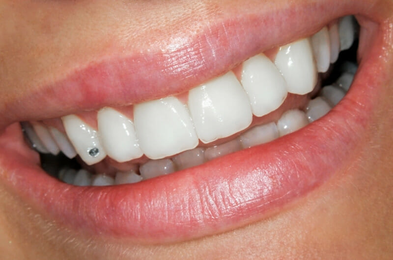 This sis a photo of a ladie's smile with a Swarovski tooth gem applied to one of her teeth